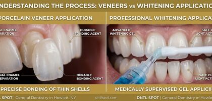 Teeth Whitening vs. Veneers