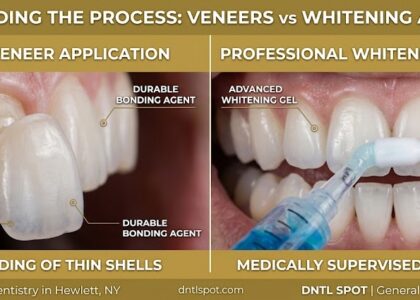 Teeth Whitening vs. Veneers