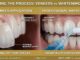 Teeth Whitening vs. Veneers