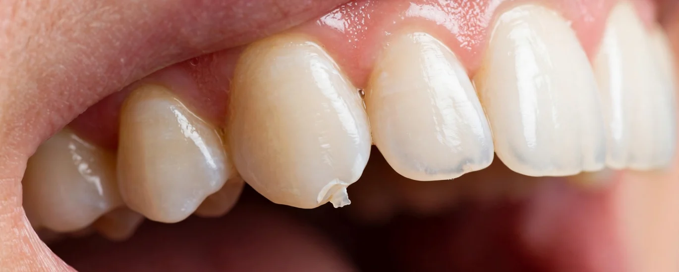 Chipped tooth with visible chip on the edge
