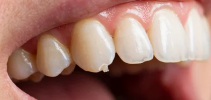 Chipped tooth with visible chip on the edge