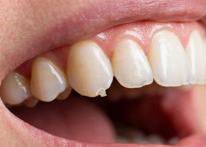 Chipped tooth with visible chip on the edge