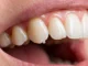 Chipped tooth with visible chip on the edge