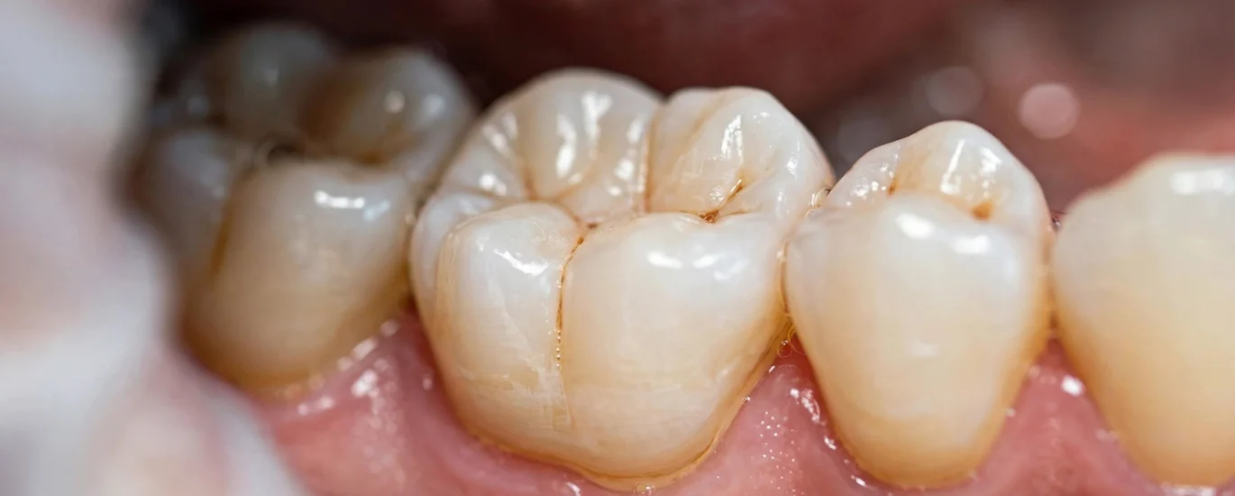 Dental crowns on a molar tooth