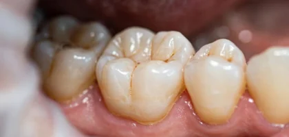 Dental crowns on a molar tooth