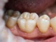 Dental crowns on a molar tooth
